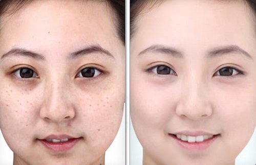 Mụn, tàn nhan và thâm nám giảm rõ rệt